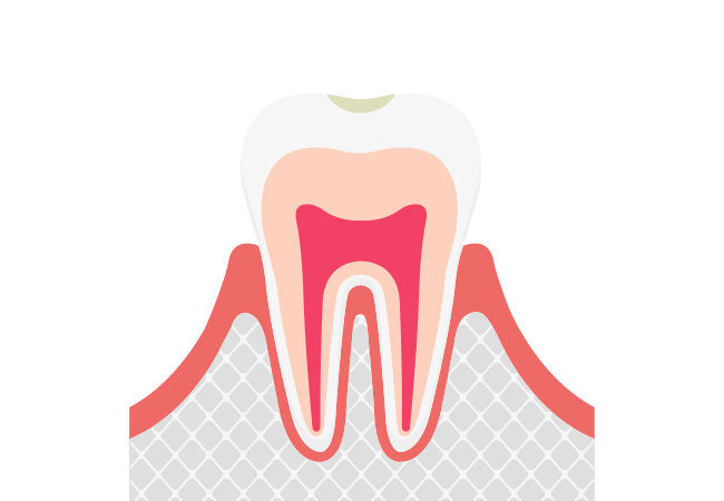 初期むし歯（C0〜C1）