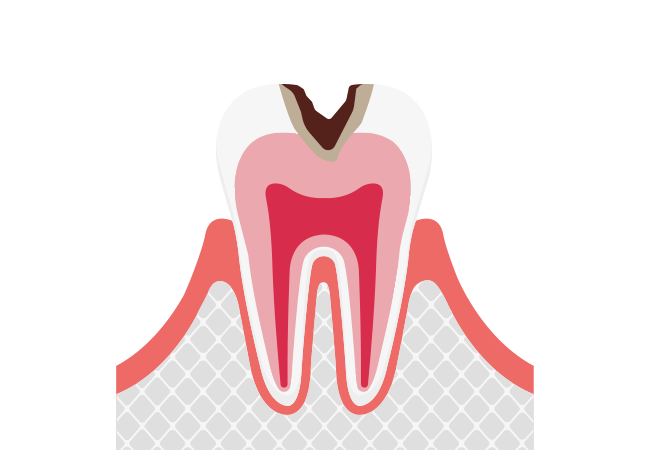 中程度のむし歯（C2）
