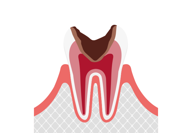 神経に達したむし歯（C3）