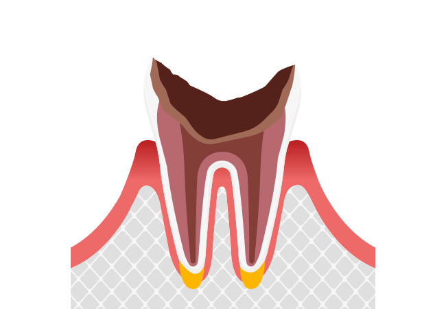 歯の大部分が崩壊したむし歯（C4）