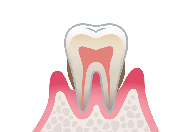 軽度歯周炎