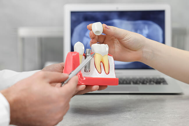 インプラント治療
