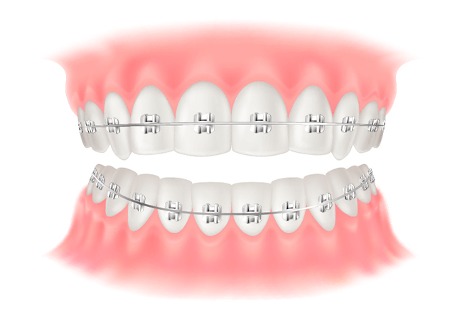 ワイヤー矯正(ブラケット矯正)
