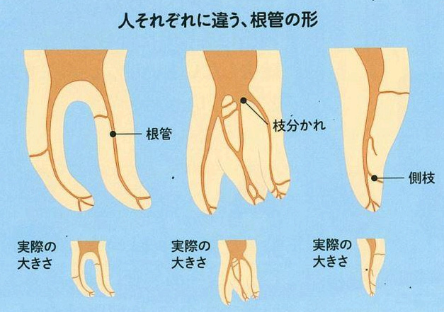 根管の形　イラスト